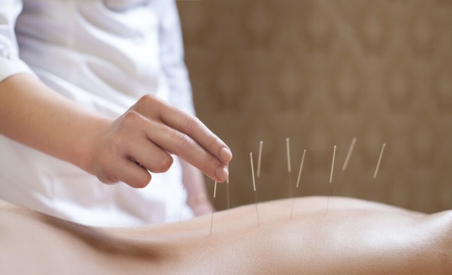 acupuntura