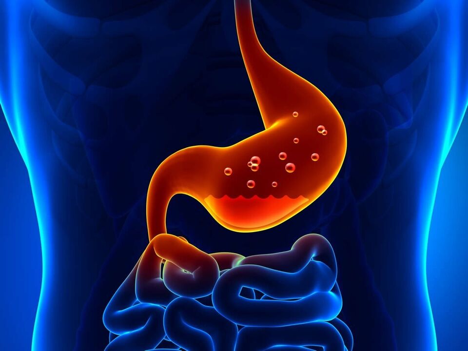 La gastritis es una enfermedad inflamatoria del estómago que requiere dieta